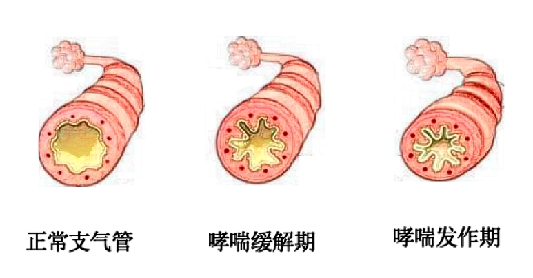 哮喘支气管